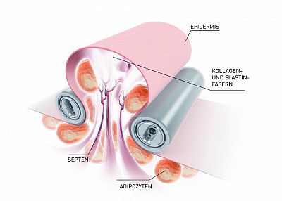 Lipomassage - štěpení tukových buněk
